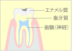 軽度のむし歯（C1）