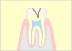 軽度のむし歯（C2）