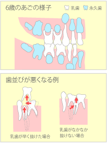 乳歯はむし歯になっても大丈夫？