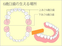 6歳臼歯について