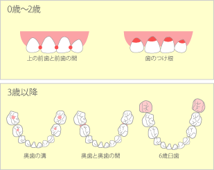 フッ素のむし歯抑制効果