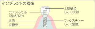 インプラントの仕組み
