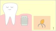 歯を失ってしまった部分のあごの骨に人工歯根（フィクスチャー）を埋め込みます