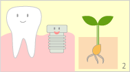 埋め込んだ歯根が骨と結合したところで、その上部に人工の歯をつけるための土台（アバットメント）を取り付けます