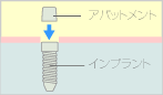 インプラント上部構造のセット