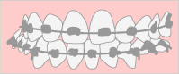 唇側矯正装置（マルチブラケット）