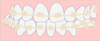 唇側矯正装置（セラミックブラケットなど）