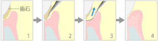 歯周ポケット掻爬術（新付着術）