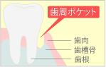 歯周ポケット