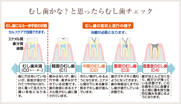 むし歯の進行表