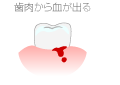 歯肉から血が出る