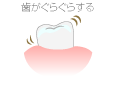 歯がぐらぐらする