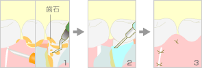 エムドゲイン法